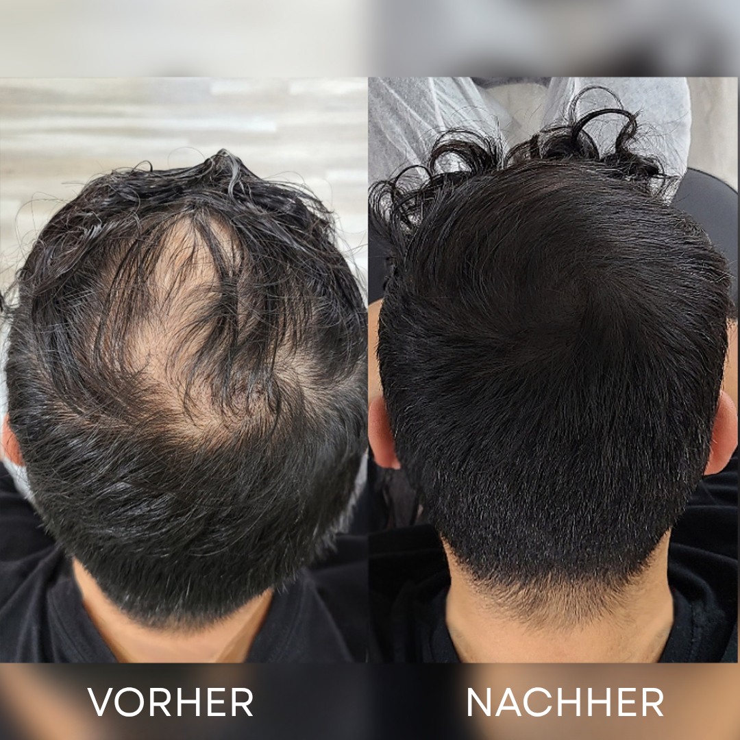AlphasHair - dichtes Haar in Sekundenschnelle
