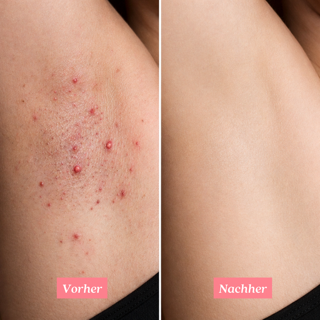 Shavelle - Nie wieder Rasierpickel nach der Rasur