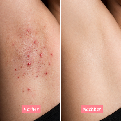 Shavelle - Nie wieder Rasierpickel nach der Rasur