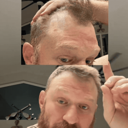 HairO - Präzisions-Stick für feiner werdende Bereiche